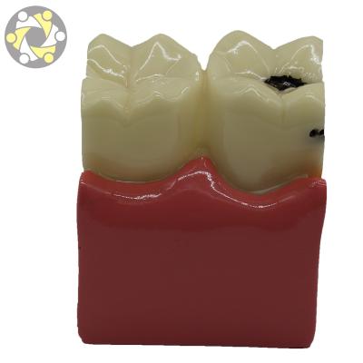 China Tooth Decay Model Pathologies Teeth Dental Study Model Education Model for sale