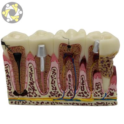 China Education Plastic Periodontal Teeth Human Medical Decay Teeth Model for sale