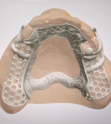 China High precision metal casting frame printing model service for dental lab for sale