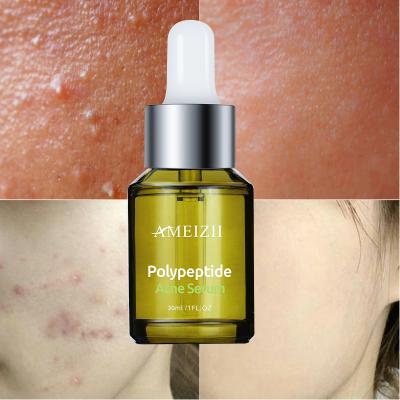 China Factory Black Herbal Facial Serum Anti Bacterial Face Serum Brown Spot Dark Spot Acne Head Remover Antibacterial Facial Serum Essence Skin Repairing Polypeptide Serum for sale