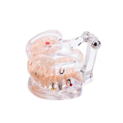 China 32 Tooth Full Month Implant Disease Teeth Model Clear Design  Dental Pathology Model for sale