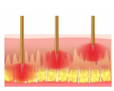 China Edad 2021 de arrugas d'eliminacion de l'Anti-blister rf fractional de microagujas anti for sale