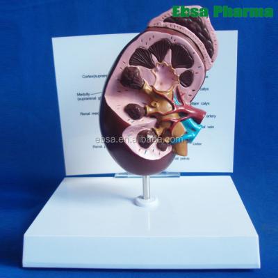 China PVC Advanced Medical Supplies Human Teaching Sick Kidney Anatomical Model For Medical School for sale