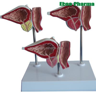 China PVC Advanced Medical Supplies Teaching Human Prostate And Bladder Sick Model for sale