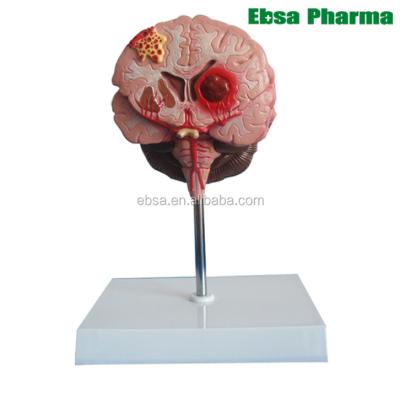 China PVC Advanced Medical Supplies Teaching Brain Epilepsy Anatomical Model For Human Medicine for sale