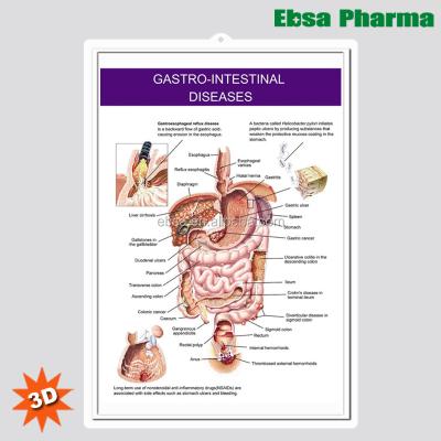 China PVC 3D Medical Human Anatomy Wall Charts / Poster - Gastro Intestinal Diseases for sale