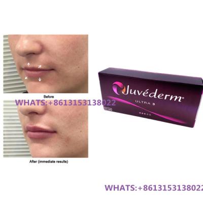 Cina Juvederm Dermal Filler per labbra Juvederm Ultra3 Ultra4 Fillers Siringa preriempita in vendita