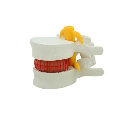 China Anatomical Medical Human Lumbar Vertebra Enlargement Disc Herniation Demonstration Lumbar Spine Model for sale