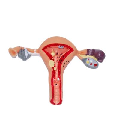 China Wholesale Female Pathological Uterus Ovary PVC Factory PVC 3d Anatomical Model for sale