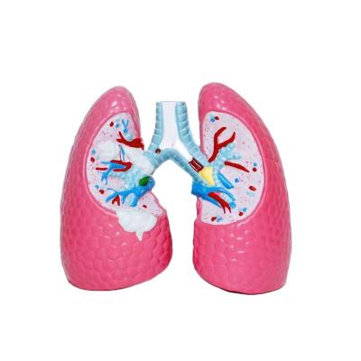 China Lung Disease PVC Production 16cm Professional Medical Science Anatomical Model for sale