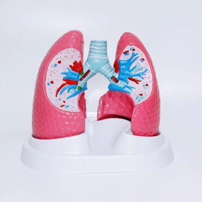 China Lung Pathology Human Organs Teaching Model 19*13*17cm for sale