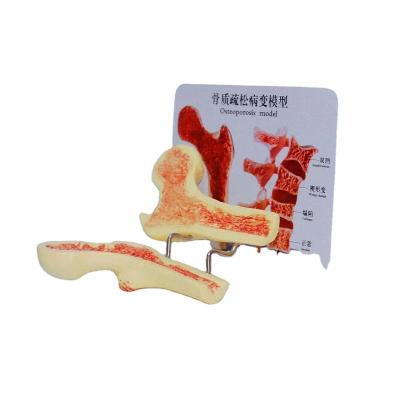 China PVC Factory Supply High Performance Teaching Model Osteoporosis Skeletal Model for sale