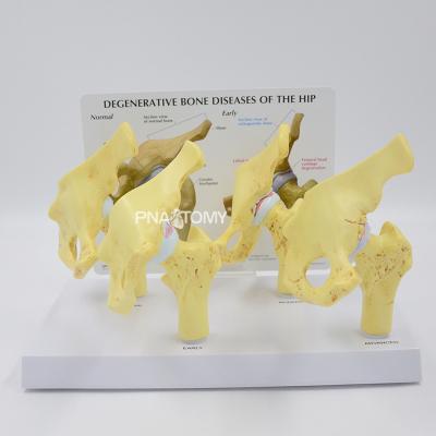 China HIP HUMAN SKELETAL ANATOMICAL MODEL EQUIPMENT EDUCATIONAL BONE ANATOMY Promotion Gift 4-STAGE Medical BONE DISEASES for sale