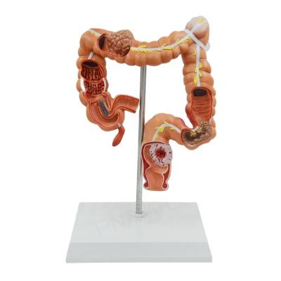 China Anatomical Organ Anatomy Digestive System Human Demonstration Sick Large Intestines PNT-07451 for sale