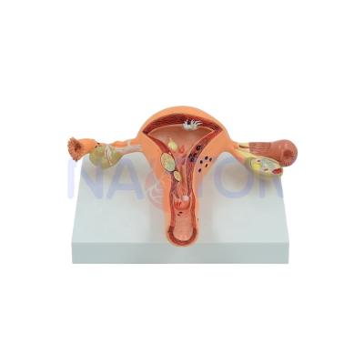 China Uterus Anatomical Artificial Female Sick Organ Demonstration Anatomical Model PNT-0742 for sale