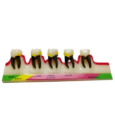 China Oral Resin Periodontal Disease Display Model for sale