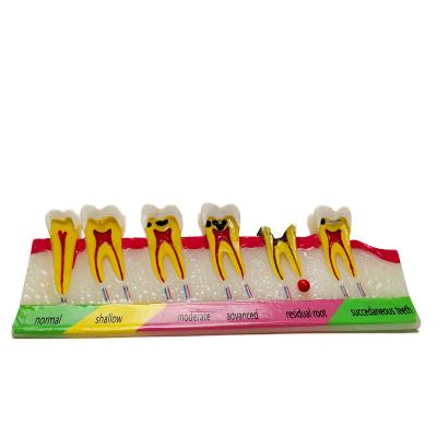 China Resin tooth oral anatomy showing caries development and change process for sale