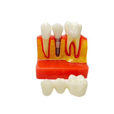 China Resin Magnified 4 Times Dental Teaching Implant Show Model for sale