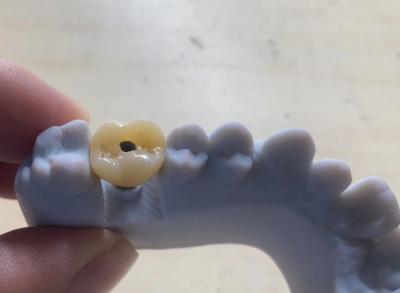 China High Precision Implant Supported Crown Stable And Easy Maintenance for sale