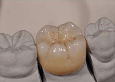 China Alta estética Noritake Zirconia cor natural estável para coroa completa de zirconia à venda