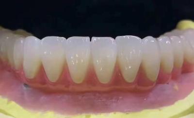 China Coroa dentária de zircônia personalizada resistente a manchas com alta precisão à venda