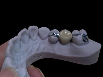 China Dental de puente de Maryland de larga duración y blanco, personalizable para la restauración. en venta