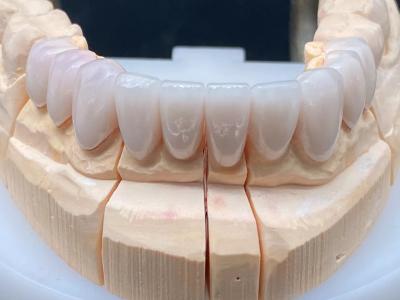 China Dental Lab E Max Ceramic Crown High Translucent with Corrosion Resistance for sale