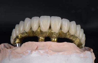 China Implantes dentales y coronas de aleación de titanio de aspecto natural y resistentes a la corrosión en venta