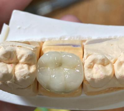 China Precisión estética Dental fuerte PFM porcelana fundida a la corona de metal en odontología en venta