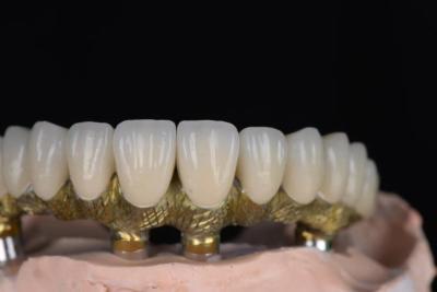 China Natural Looking Crown Porcelain Fused To Metal High Precision For Dental Implants for sale