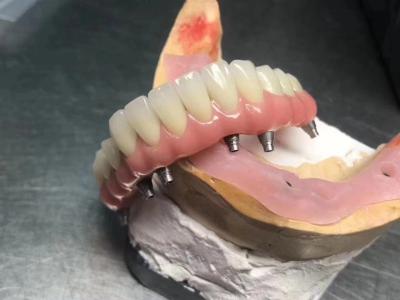 Cina Impianto solido ad alta traslucidità corone supportata personalizzabile per la restaurazione dentale in vendita