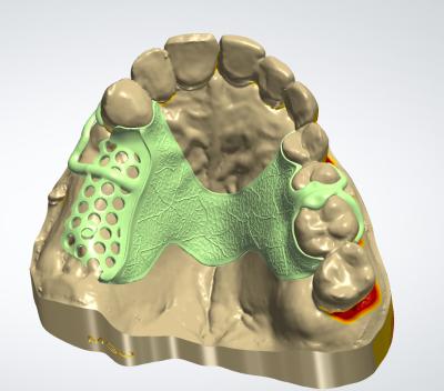 China Digital Metal Framework CAD CAM Dental Design Cocr Material With 3D Printing for sale