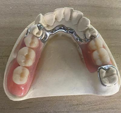 China Reliable Silver Metal Frame Denture Corrosion Resistance With Customizable Design for sale