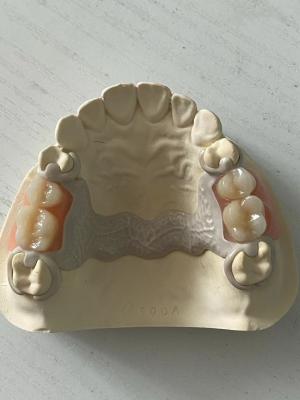 China Customized Dental PEEK Acrylic Partial Denture Adjustable With Secure Fit for sale