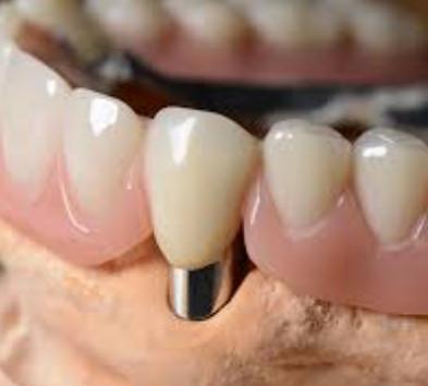 China Coroa Dental Telescópica Personalizável de Alta Precisão com Aparência Natural à venda