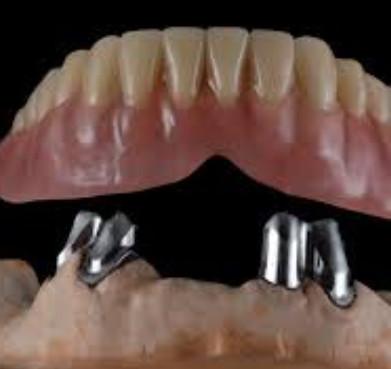 China Comfortable Easy Maintenance Telescopic Crowns Customized For Dental Restoration for sale