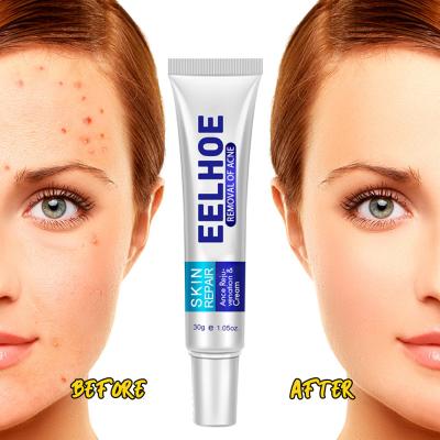 China Skin Revitalizer New Arrival Acne Scar Removal Cream Acne Cream 30g Anti Whitening Moisturize Acne Treatment Facial Cream for sale