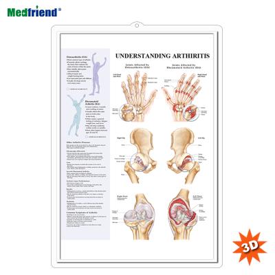 China PVC Material Authorized Educational Plastic Medical Anatomical Chart /Poster - 3D Wall Understanding Arthritis for sale