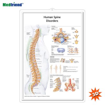 China PVC Material Authorized Educational Plastic Medical Anatomical Chart /Poster - Human Spine Wall 3D Disorders for sale