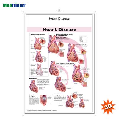 China PVC Material Authorized Educational Plastic Medical Anatomical Chart /Poster - 3D Wall Heart Disease for sale