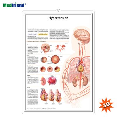 China PVC Material Authorized Educational Plastic Medical Anatomical Chart /Poster - 3D Wall Understanding Hypertension for sale