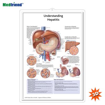 China PVC Material Authorized Educational Plastic Medical Anatomical Chart /Poster - 3D Wall Understanding Hepatitis for sale