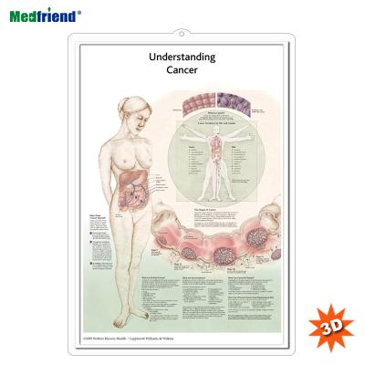 China PVC Material Authorized Educational Plastic Medical Anatomical Chart /Poster - 3D Wall Understanding Cancer for sale