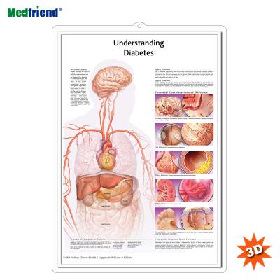 China PVC Material Authorized Educational Plastic Medical Anatomical Chart /Poster - 3D Wall Understanding Diabetes for sale