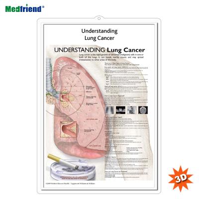 China PVC Material Authorized Educational Plastic Medical Anatomical Chart /Poster - 3D Wall Understanding Lung Cancer for sale