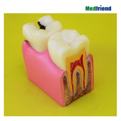 China Patients Worries 6X Pathology Tooth Decay Model Dental Comparasion Dental Study Model Demonstration Model for sale