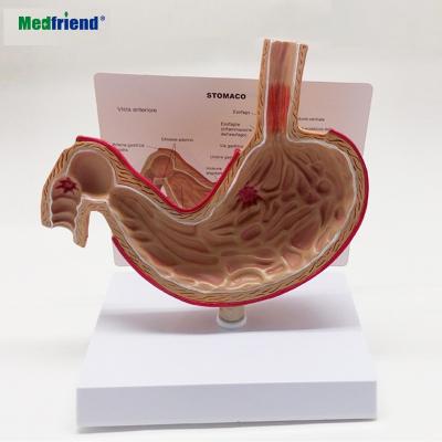 China Patients Care Demonstration Stomach Anatomic Ill Stomach Model With Esophageal Gastric Ulcer Inflammation for sale