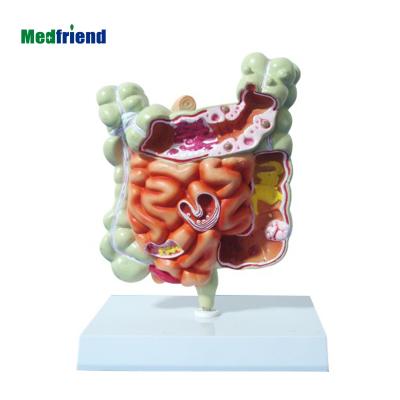 China Patients Care Familiar Disease Demonstration Model With Colon Rectum GI Area Model for sale