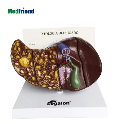 China Patients Care Demonstration 4 Stage Anatomical Liver Model With Pathologies Liver Cancer Model for sale