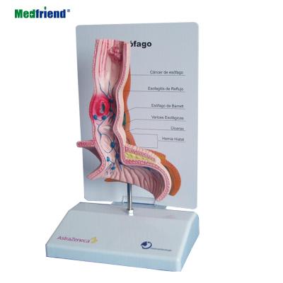 China Patients Care Medical Anatomical Sick Esophageal Demonstration Model for sale